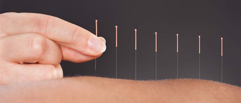 Acupuncture